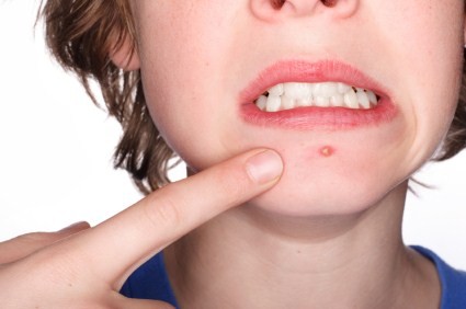 A teenager with a pimple on his chin.