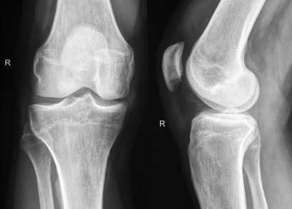 An x-ray of 2 knee joints.