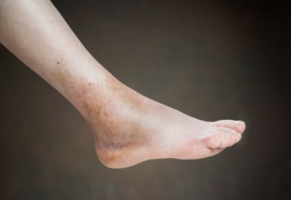 A close up photo of a bruised foot.