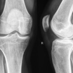 An x-ray of 2 knee joints.