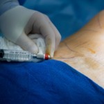 A man receiving liposuction surgery.