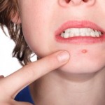 A teenager with a pimple on his chin.
