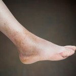 A close up photo of a bruised foot.